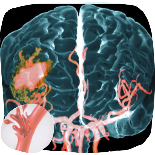 Illustration of a hemorrhagic stroke in the brain