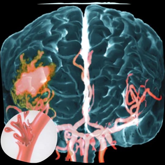 Illustration of a hemorrhagic stroke in the brain