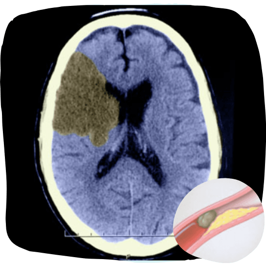 CT scan illustrating an ischemic stroke